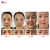 Best Face Lifting Machine Wrinkle Removal