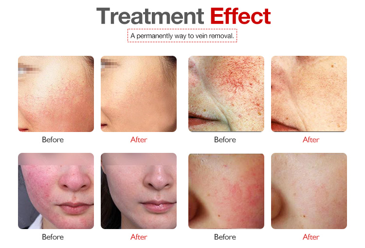 Laser vascular vein removal 30W face and body use Laser vascular vein removal skin care