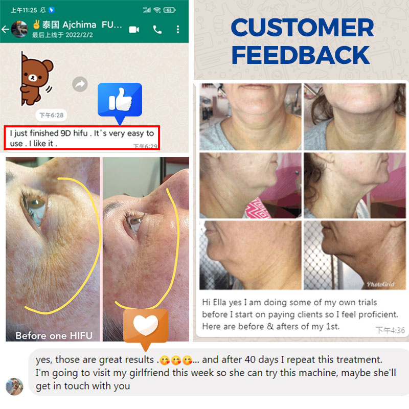 hifu machine philippines for skin lifting anti aging