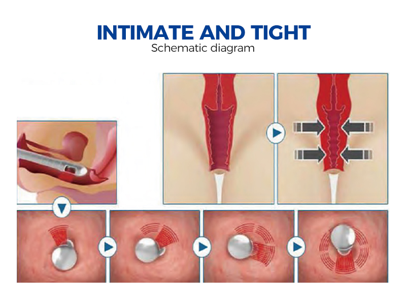 Buy Fractional Co2 Laser Machine