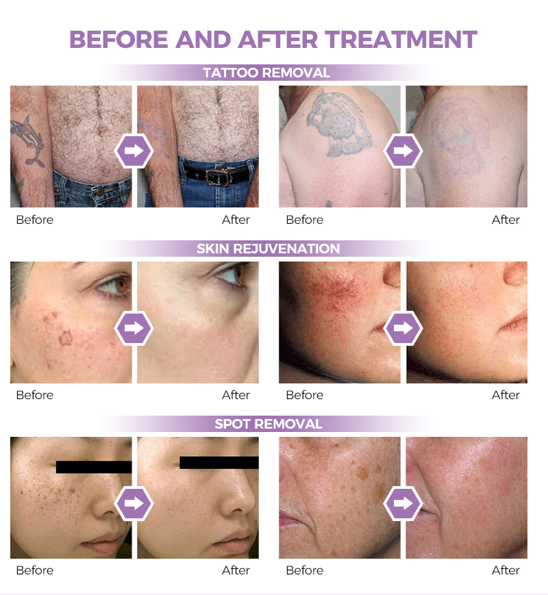 Laser Tattoo Removal Machine for Sale