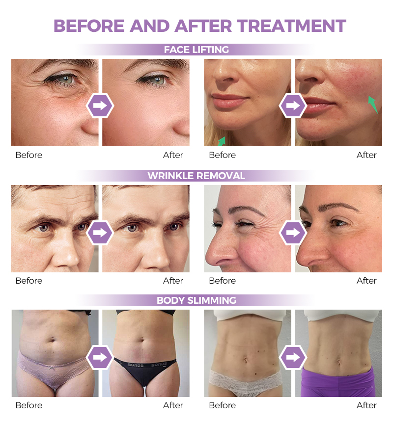 HIFU medical equipment for salon and clinic