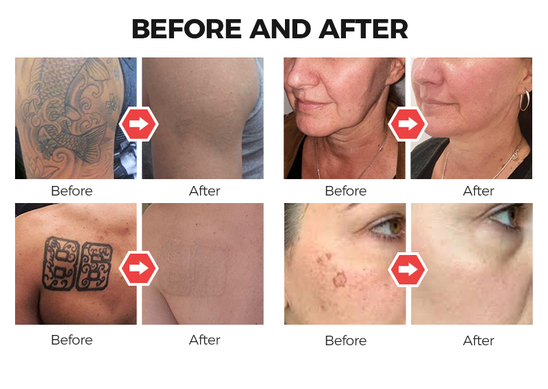 Laser Tattoo Removal Machine Cost