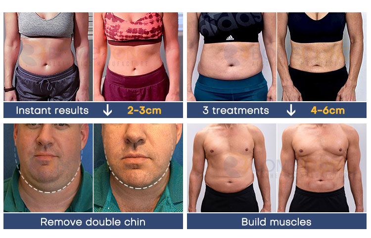 EMS Monopolar RF Sculpting Machine Radio Frequency