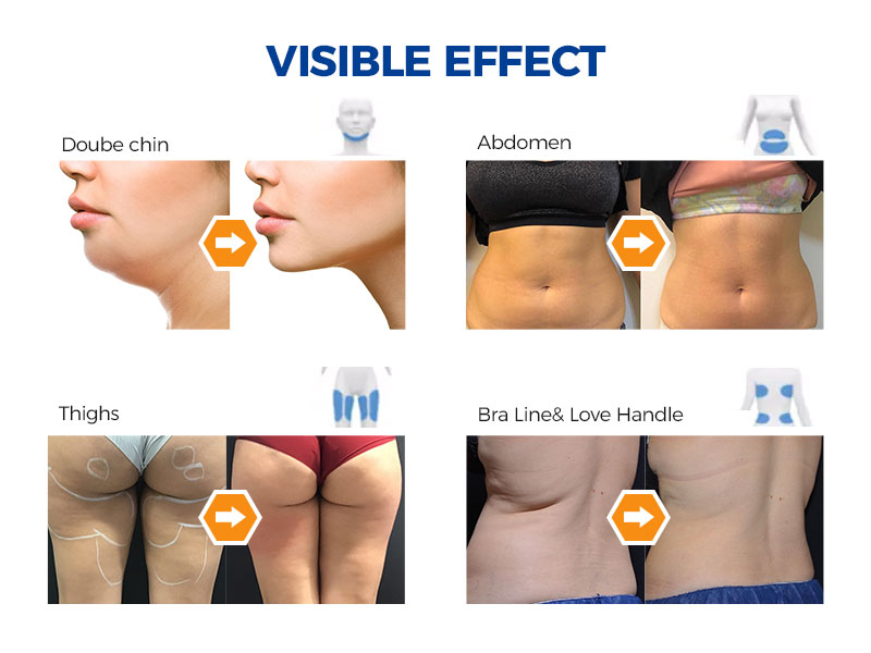 Cryolipolysis Machine Freeze Fat 360 Body Shaping Beauty Slimming ETG80S