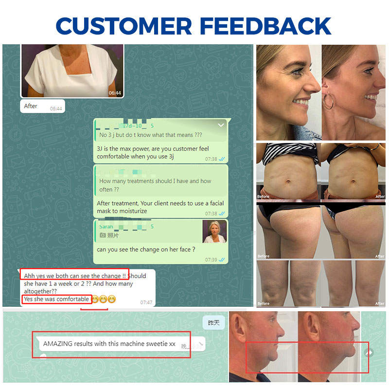 hifu machine philippines for skin lifting anti aging