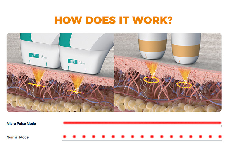 HIFU machine thailand for skin lifting wrinkle removal