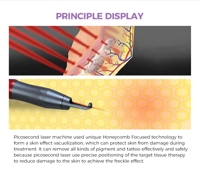 Laser Tattoo Removal Machine for Sale