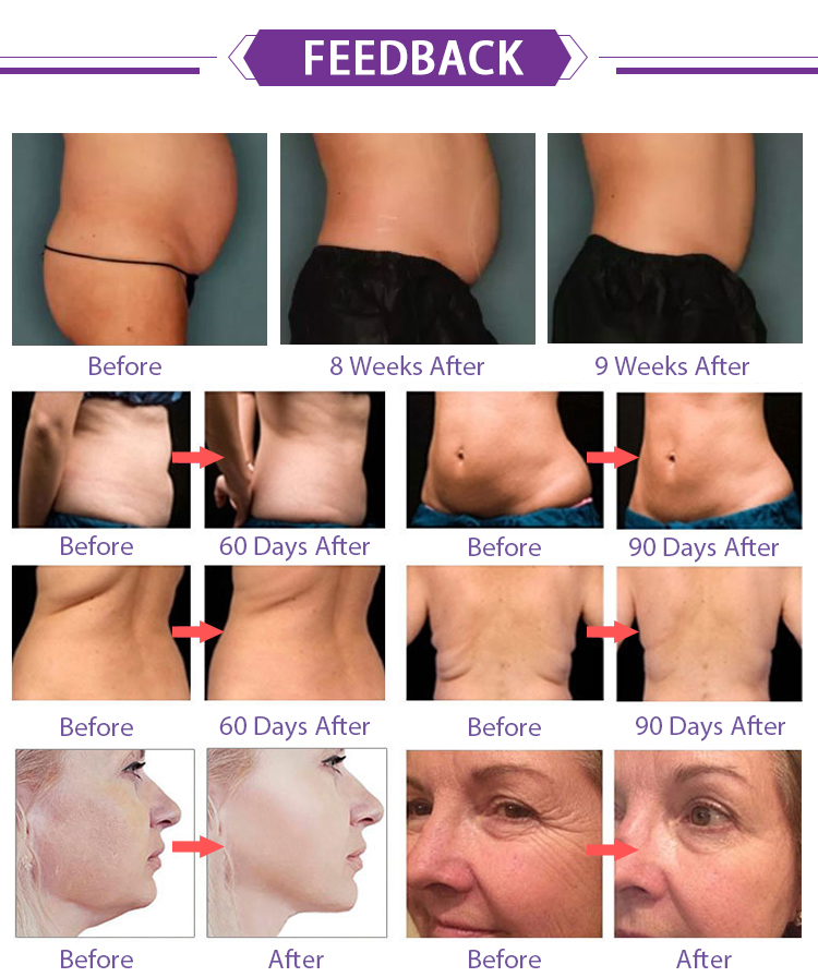 HIFU machine for easy use skin lifting anti aging