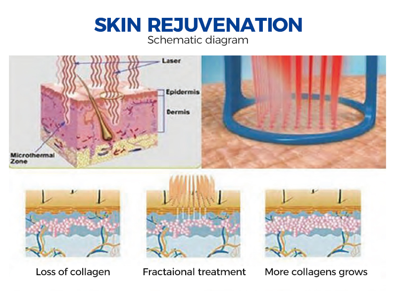 Buy Fractional Co2 Laser Machine