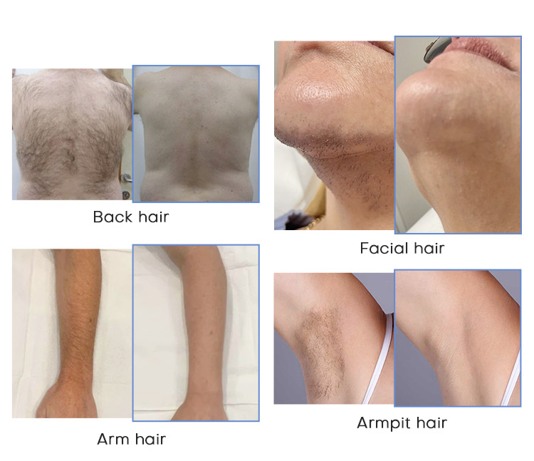Diode laser hair removal alibaba machine hot selling