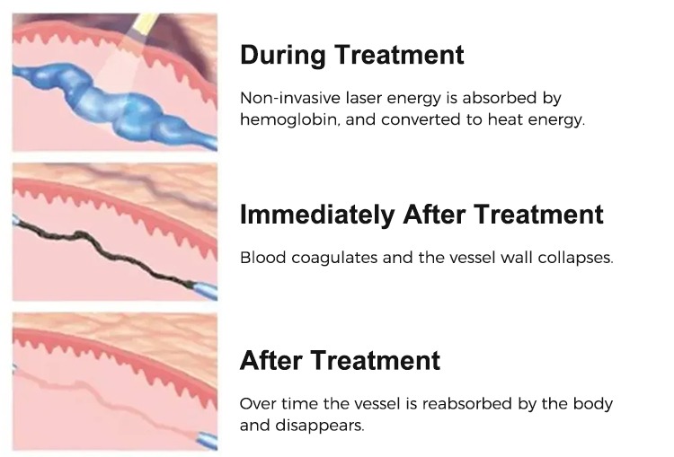 Hair Removal Beauty Machine Painless Skin Rejuvenation