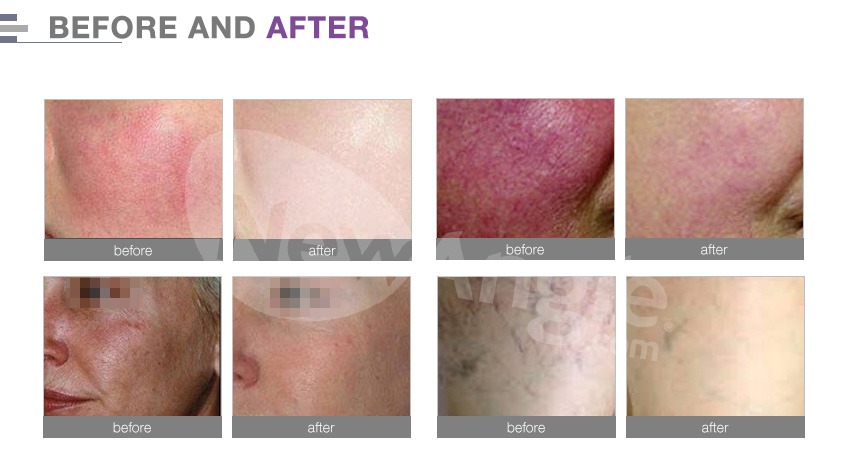 Spider Vein Removal Machine Laser Diode 980nm