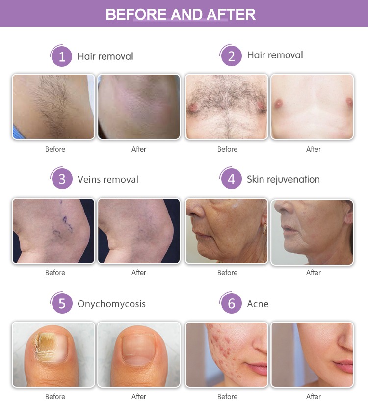 Hair Removal Beauty Machine Painless Skin Rejuvenation