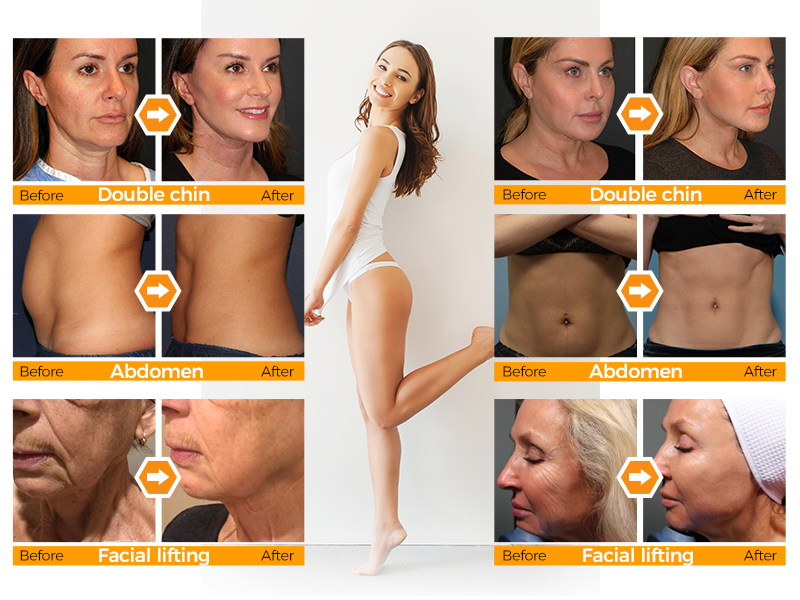 Face and body skin lifting 9D hifu machine buy