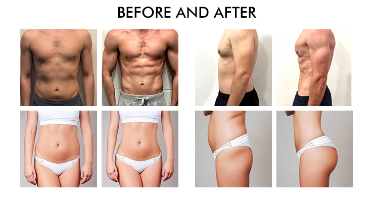 Ems RF Slimming Machine Abdominal Muscles Building Abs EMS RF 2 In 1 Machine