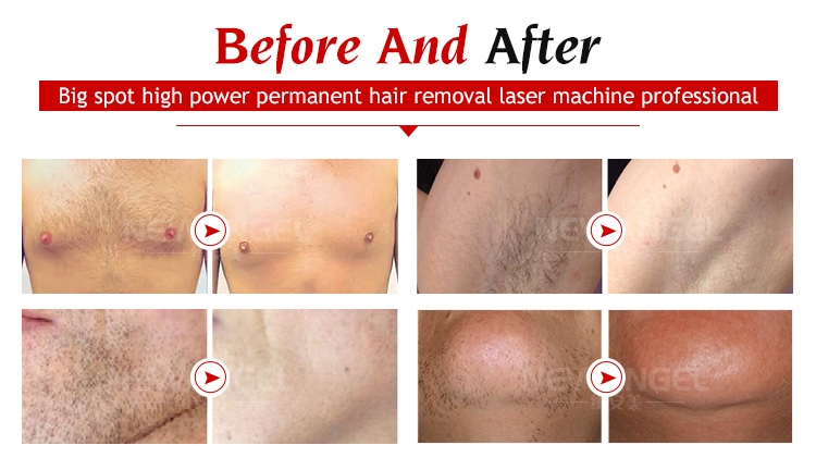 High power diode laser hair removal machine manufacturers