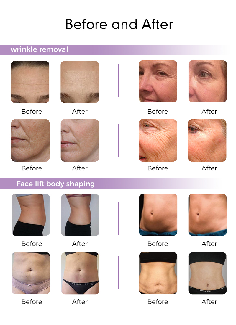 Best Hifu Machine for Salon Use