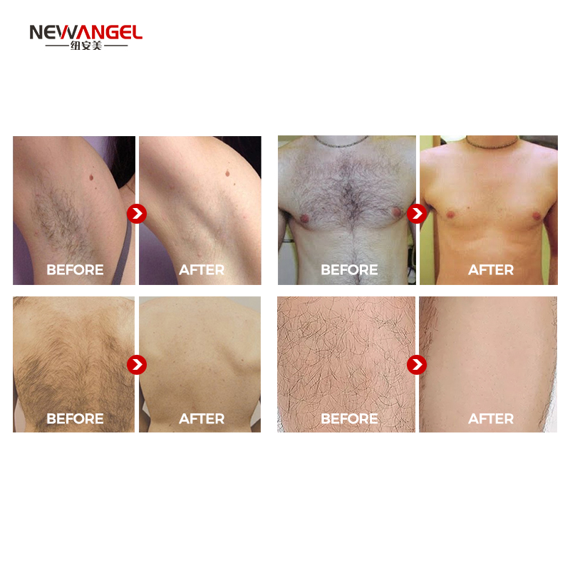 What Is The Newest Laser Hair Removal Machine