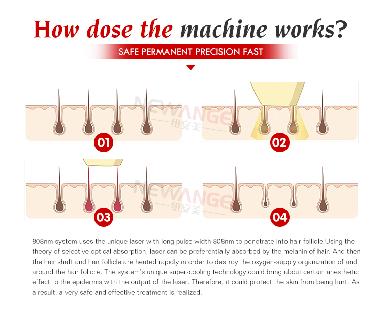 Diode Laser 808nm Hair Removal Machine New Trending Salon Oed Odm Logo Customization Painless Hair Removal