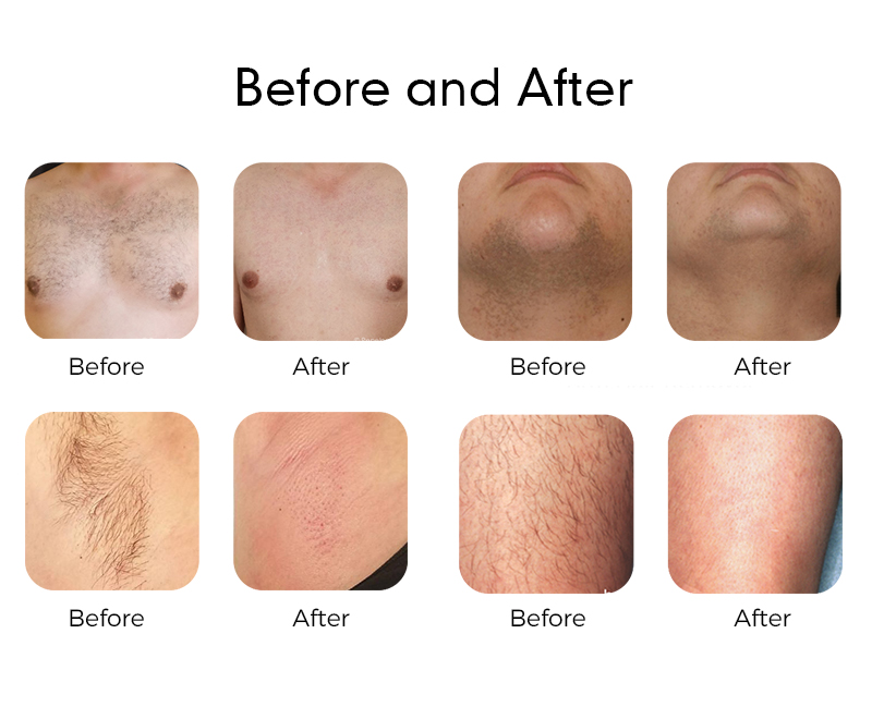 Top 10 FDA Approved Diode Laser Hair Removal Machines 2026