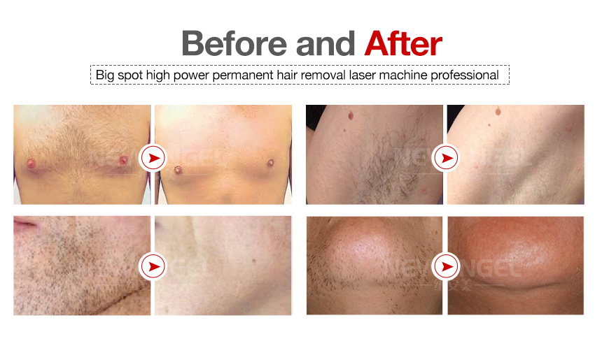 Laser hair removal prices 808nm machine skin rejuvenation beauty