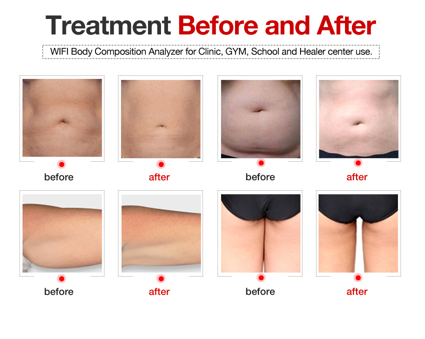 Laser diode 1060nm machine for weight loss body slimming