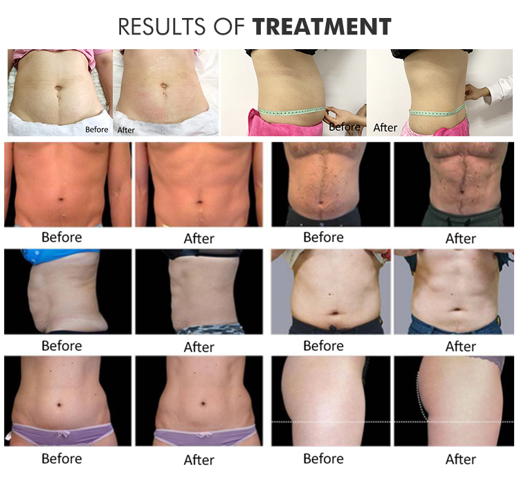 Cryolipolisis Body Slimming Belt Fat Freezing 360 Cryo Machine