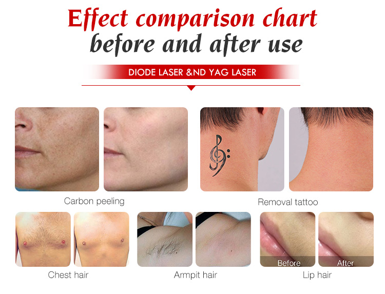 Tattoo removal machine diode laser hair removal pigmentation removal