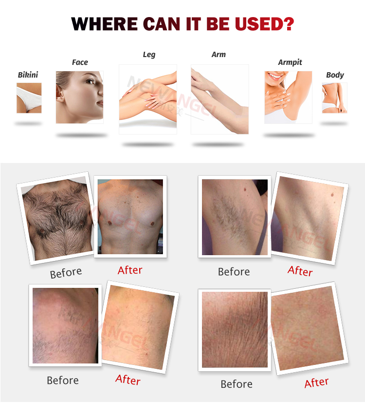 Diode laser hair removal machine 755 1064 808 nm Beauty salon permanent painless whitening 