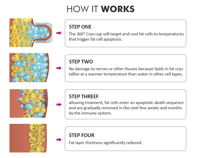 Cryolipolisis Body Slimming Belt Fat Freezing 360 Cryo Machine