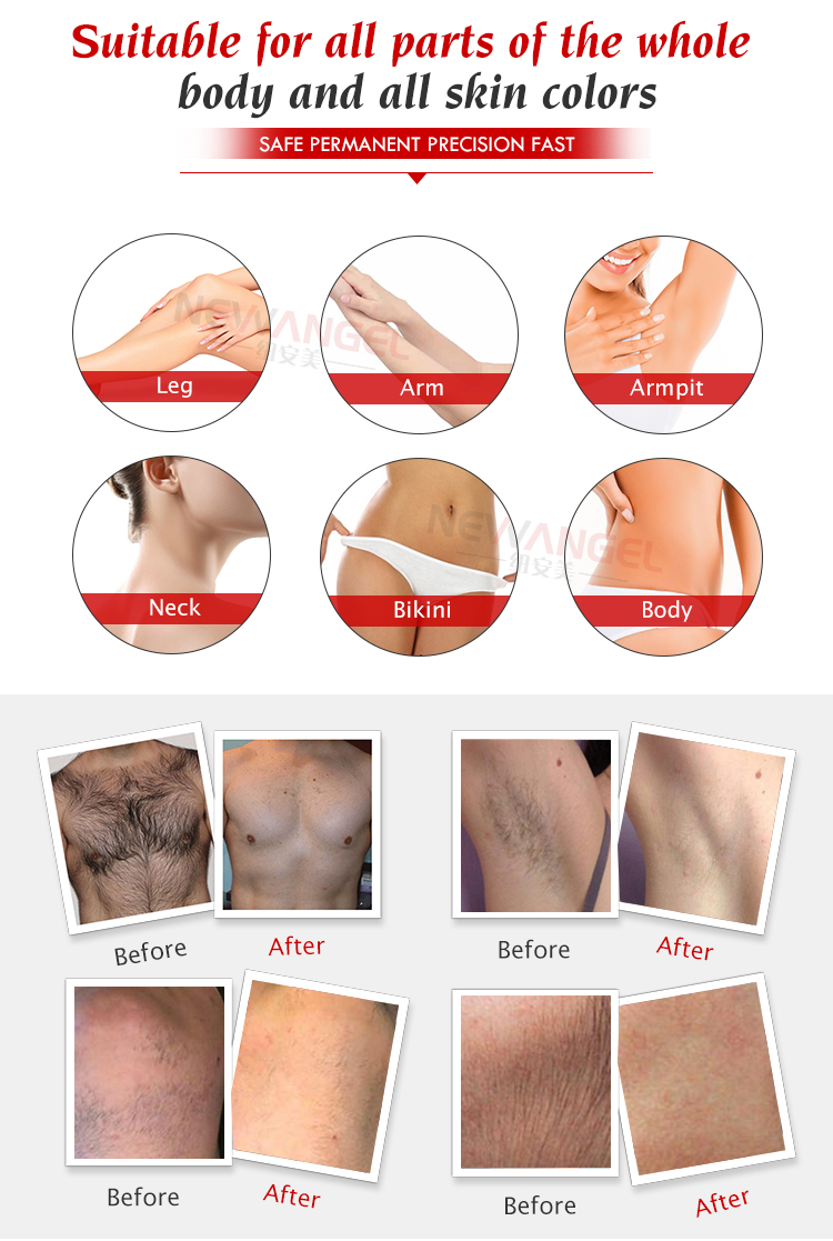 Diode Laser 808nm Hair Removal Machine New Trending Salon Oed Odm Logo Customization Painless Hair Removal