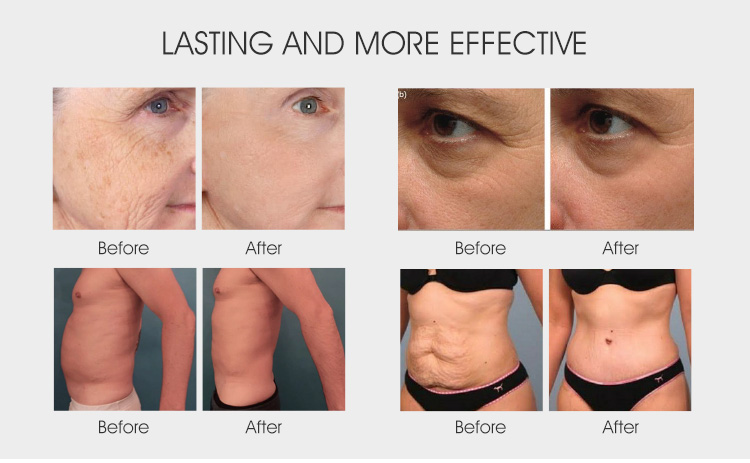 Newangel 7d Facial Skin Tightening Wrinkle Removal Body Slimming Machine