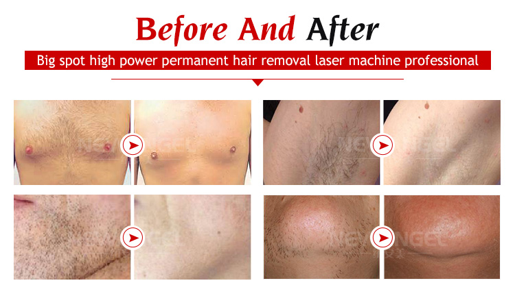 permanent back hair removal