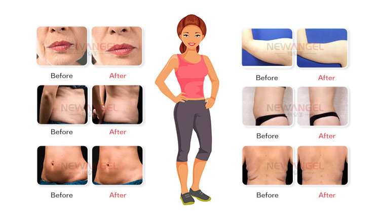 40k Ultrasonic Vela Weight Loss Body Slimming Rf Vacuum Cavitation Machine Ce Approved for Salon