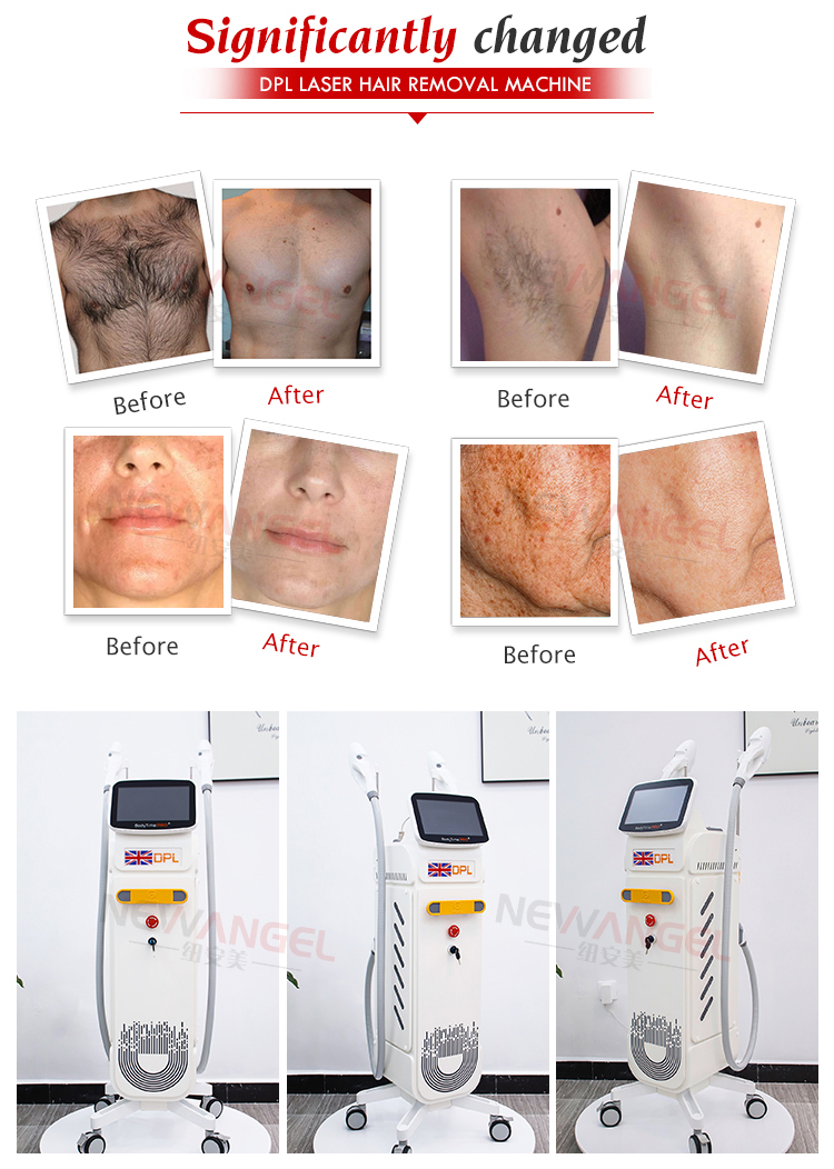 dpl hair removal ipl laser machine Painless safe permanent pore