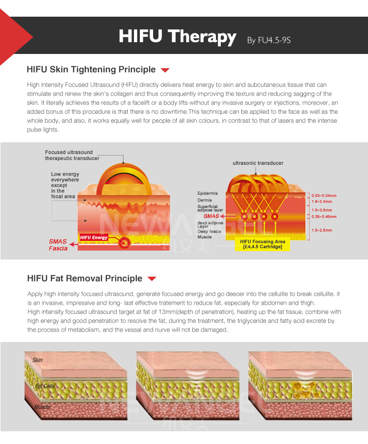 Hifu portable machine easily to create beautiful skin FU4.5-9S