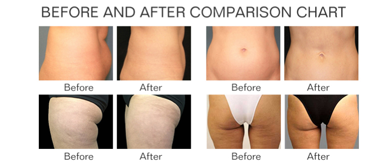 532nm Laser 6D Laser Non-invasive Laser Slimming Equipment Painless