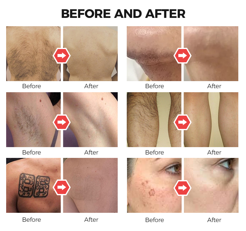 Diode Nd Yag IPL Laser Machine Hair Removal Tattoo Removal Skin Rejuvenation