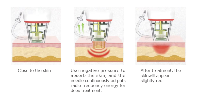 2025 Professional Microneedling Device for Clinics