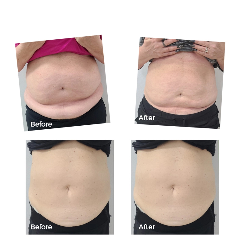 melanotan 2 usa reddit Melanotan II  Complete Guide