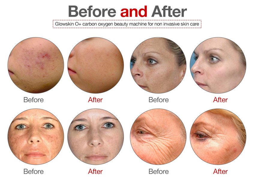 Glowskin O+ carbon oxygen machine exporters