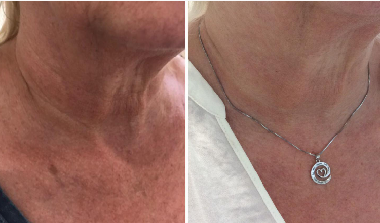 Does HIFU machine remove all wrinkles from front of neck