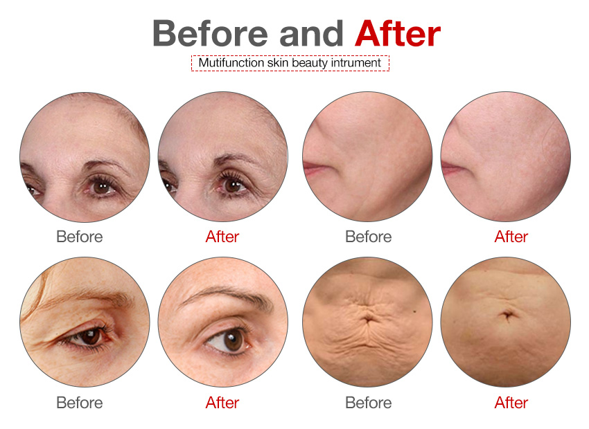 skin treatment jet peel machine for sale