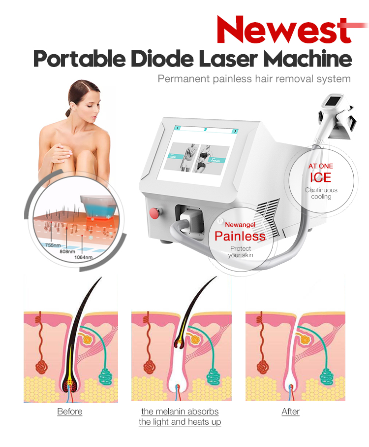 Germany portable diode laser hair removal machine