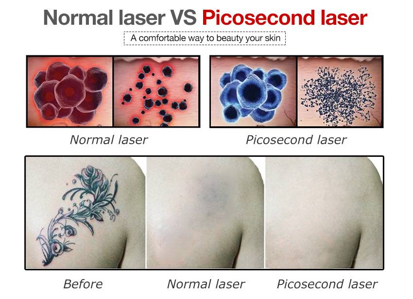 permanent tattoo removal laser for sale