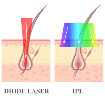 Diode VS IPL Laser Hair Removal System.
