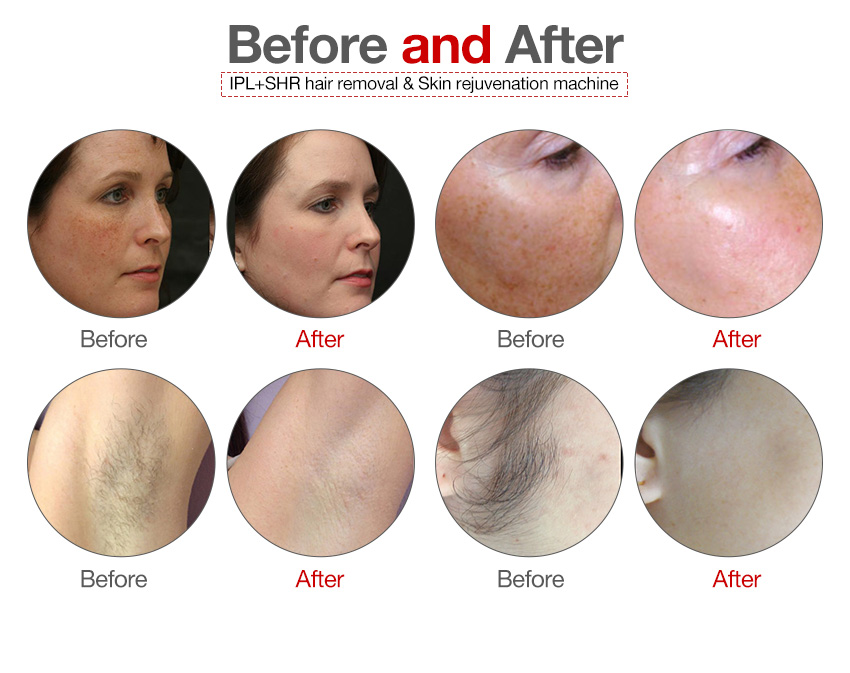 IPL SHR hair removal contrast before and after