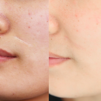 Fractional CO2 laser acne removal before and after