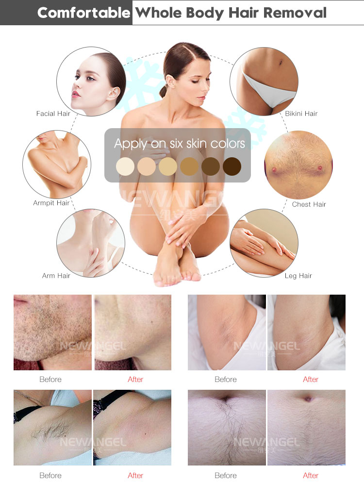 diode hair removal laser machine for whole body use